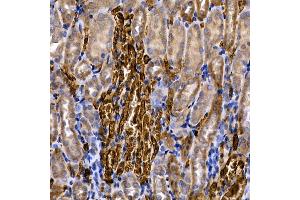 Immunohistochemistry of paraffin-embedded human colon carcinoma using Caspase-8 Rabbit pAb (ABIN6131530, ABIN6137970, ABIN6137972 and ABIN6213676) at dilution of 1:200 (40x lens). (Caspase 8 antibody  (AA 1-479))