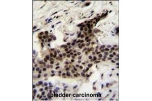 UBXN2A Antibody (C-term) (ABIN655308 and ABIN2844890) immunohistochemistry analysis in formalin fixed and paraffin embedded human bladder carcinoma followed by peroxidase conjugation of the secondary antibody and DAB staining. (UBXN2A antibody  (C-Term))