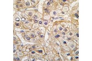 IHC analysis of FFPE human hepatocarcinoma tissue stained with the EGF Receptor antibody (EGFR antibody  (AA 1048-1077))