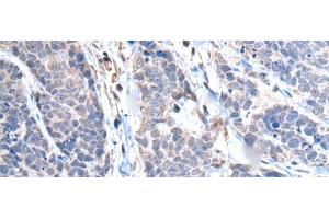 Immunohistochemistry of paraffin-embedded Human thyroid cancer tissue using TRIM27 Polyclonal Antibody at dilution of 1:65(x200)