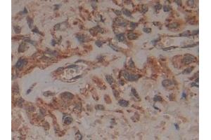 Detection of FADD in Human Lung cancer Tissue using Polyclonal Antibody to Fas Associating Death Domain Containing Protein (FADD) (FADD antibody  (AA 12-206))