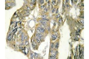 Immunohistochemistry analysis of TNF-alpha Antibody in paraffin-embedded human colon carcinoma tissue. (TNF alpha antibody)