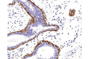 Immunohistochemistry analysis of paraffin-embedded human breast cancer using TAGLN Polyclonal Antibody at dilution of 1:400. (Transgelin antibody)