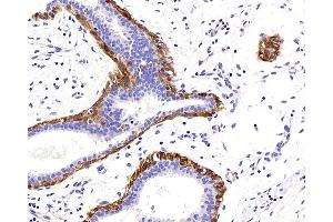 Immunohistochemistry analysis of paraffin-embedded human breast cancer using TAGLN Polyclonal Antibody at dilution of 1:400.