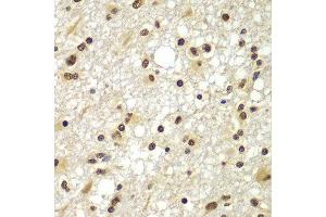 Immunohistochemistry of paraffin-embedded human brain cancer using ZNF20 antibody at dilution of 1:100 (x400 lens).
