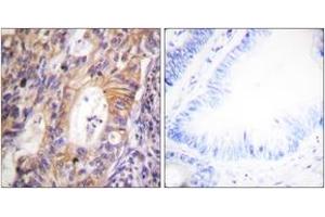 Immunohistochemistry analysis of paraffin-embedded human colon carcinoma, using c-Met (Phospho-Tyr1003) Antibody. (c-MET antibody  (pTyr1003))