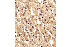 (ABIN6242565 and ABIN6578213) staining PGM1 in human liver tissue sections by Immunohistochemistry (IHC-P - paraformaldehyde-fixed, paraffin-embedded sections). (Phosphoglucomutase 1 antibody  (AA 469-501))