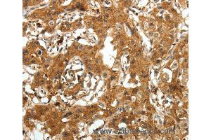 Immunohistochemistry of Human lung cancer using AMD1 Polyclonal Antibody at dilution of 1:30