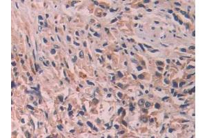 DAB staining on IHC-P;;Samples: Human Prostate cancer Tissue