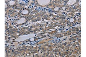 The image on the left is immunohistochemistry of paraffin-embedded Human thyroid cancer tissue using ABIN7191523(MT-ND3 Antibody) at dilution 1/30, on the right is treated with synthetic peptide. (MT-ND3 antibody)