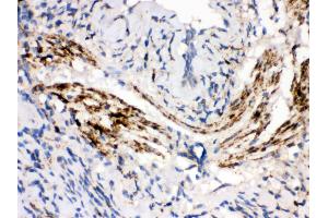Anti- MAOB Picoband antibody,IHC(P) IHC(P): Human Lung Cancer Tissue (Monoamine Oxidase B antibody  (C-Term))