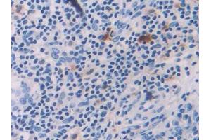 DAB staining on IHC-P; Samples: Human Skin cancer Tissue (IL-18 antibody  (AA 37-193))