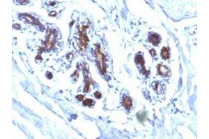 Immunohistochemical staining (Formalin-fixed paraffin-embedded sections) of human breast carcinoma with MFGE8 monoclonal antibody, clone EDM45 . (MFGE8 antibody)