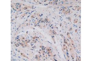 Used in DAB staining on fromalin fixed paraffin- embedded prostate gland cancer tissue (ALOX15B antibody  (AA 253-490))