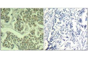 Immunohistochemical analysis of paraffin-embedded human breast carcinoma tissue using eIF2α (Phospho-Ser49) Antibody (left) or the same antibody preincubated with blocking peptide (right). (EIF2S1 antibody  (pSer49))