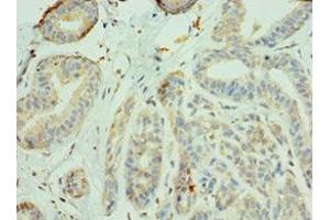 Immunohistochemistry of paraffin-embedded human breast cancer using ABIN7156335 at dilution of 1:100 (IRS1 antibody  (AA 1-160))