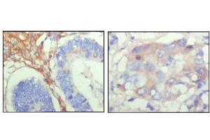 Immunohistochemical analysis of paraffin-embedded human colon cancer (left) and breast cancer (right) showing cytoplasmic localization with DAB staining using FBLN5 mouse mAb. (Fibulin 5 antibody)
