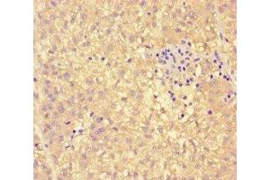 Immunohistochemistry of paraffin-embedded human liver cancer using ABIN7163147 at dilution of 1:100 (PEBP4 antibody  (AA 23-227))