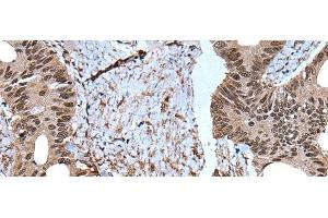 Immunohistochemistry of paraffin-embedded Human colorectal cancer tissue using ZNF787 Polyclonal Antibody at dilution of 1:45(x200) (ZNF787 antibody)