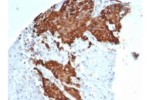 Formalin-fixed, paraffin-embedded human ovarian carcinoma stained with Tubulin beta 3 Recombinant Rabbit Monoclonal Antibody (TUBB3/7089R). (Recombinant TUBB3 antibody  (AA 437-450))