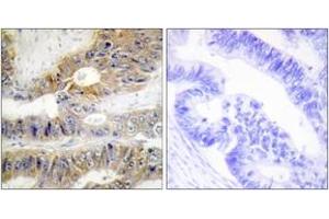 Immunohistochemistry analysis of paraffin-embedded human colon carcinoma tissue, using TNFRSF6B Antibody.