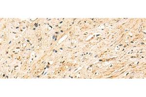 Immunohistochemistry of paraffin-embedded Human prost at e cancer tissue using EEF1AKMT2 Polyclonal Antibody at dilution of 1:50(x200) (METTL10 antibody)