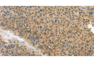 Immunohistochemistry of paraffin-embedded Human liver cancer tissue using ACLY Polyclonal Antibody at dilution 1:40 (ACLY antibody)