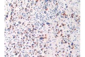 IHC-P analysis of Human Stomach Cancer Tissue, with DAB staining. (HSPD1 antibody  (AA 172-343))
