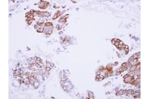 IHC-P Image Immunohistochemical analysis of paraffin-embedded human lung adenocarcinoma, using MASPIN, antibody at 1:100 dilution. (SERPINB5 antibody  (Center))
