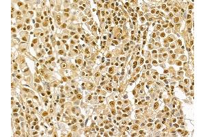 NRF1 Mouse Monoclonal Antibody at 1/100 staining human gastric cancer by IHC-P.