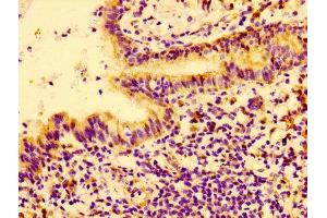 Immunohistochemistry of paraffin-embedded human lung cancer using ABIN7148441 at dilution of 1:100 (CTGF antibody  (AA 253-349))