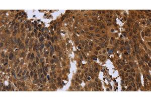 Immunohistochemistry of paraffin-embedded Human cervical cancer using FGFRL1 Polyclonal Antibody at dilution of 1:40 (FGFRL1 antibody)