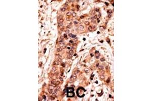 Formalin-fixed and paraffin-embedded human cancer tissue reacted with the primary antibody, which was peroxidase-conjugated to the secondary antibody, followed by AEC staining. (GUCY1A2 antibody  (C-Term))