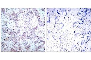Immunohistochemical analysis of paraffin-embedded human breast carcinoma tissue using NF-κB p65 (Ab-536) antibody (E021014). (NF-kB p65 antibody)