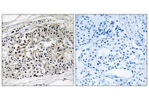Immunohistochemistry analysis of paraffin-embedded human breast carcinoma tissue using EHHADH antibody. (EHHADH antibody  (Internal Region))