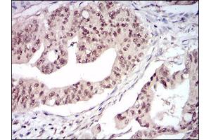Immunohistochemical analysis of paraffin-embedded rectum cancer tissues using DNMT1 mouse mAb with DAB staining. (DNMT1 antibody  (AA 1448-1594))