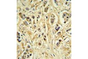 ZNF202 Antibody (Center) IHC analysis in formalin fixed and paraffin embedded breast carcinoma followed by peroxidase conjugation of the secondary antibody and DAB staining. (ZNF202 antibody  (Middle Region))