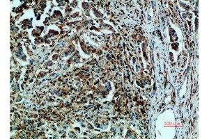 Immunohistochemical analysis of paraffin-embedded human-breast-cancer, antibody was diluted at 1:200 (GRP78 antibody  (AA 1268-1341))