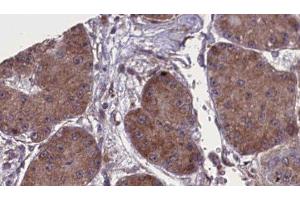 ABIN6277805 at 1/100 staining Human liver cancer tissue by IHC-P.