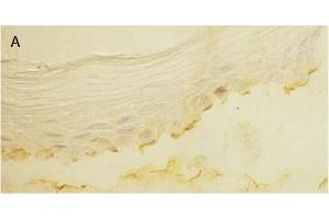 Immunohistochemistry image of Laminin 5 staining in cryosection of bullous pemphigoid Skin. (Laminin 5 antibody)