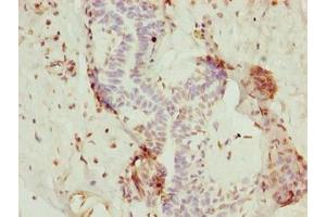Immunohistochemistry of paraffin-embedded human breast cancer using ABIN7154806 at dilution of 1:100 (rRNA 2'-O-Methyltransferase Fibrillarin (FBL) (AA 1-64) antibody)