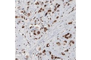 Immunohistochemical staining (Formalin-fixed paraffin-embedded sections) of human breast cancer with ARID1A monoclonal antibody, clone CL3595  shows moderate to strong nuclear immunoreactivity in tumor cells.