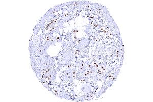 Invasive lobular breast cancer with strong nuclear GATA3 positivity of tumor cells