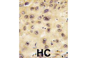 Formalin-fixed and paraffin-embedded human hepatocellular carcinoma tissue reacted with PROX1 polyclonal antibody , which was peroxidase-conjugated to the secondary antibody, followed by DAB staining. (PROX1 antibody  (Internal Region))