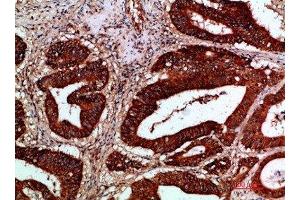 Immunohistochemical analysis of paraffin-embedded human-colon-cancer, antibody was diluted at 1:200 (IKBKG antibody  (AA 60-120))