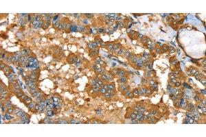 Immunohistochemistry of paraffin-embedded Human thyroid cancer using PYGL Polyclonal Antibody at dilution of 1:35 (PYGL antibody)