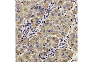 Immunohistochemical analysis of AP1-mu-2 staining in human liver cancer formalin fixed paraffin embedded tissue section. (AP1m2 antibody)