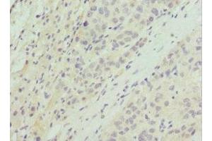 Immunohistochemistry of paraffin-embedded human liver cancer using ABIN7164754 at dilution of 1:100
