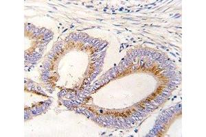 IHC analysis of FFPE human colon carcinoma tissue stained with GDF11 antibody (GDF11 antibody  (AA 32-61))