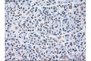 Immunohistochemical staining of paraffin-embedded Adenocarcinoma of colon tissue using anti-PLK1mouse monoclonal antibody. (PLK1 antibody)